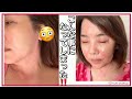 【40代以上に気をつけてほしい】こんな事になってしまった‼️かぶれ❓アレルギー❓【更年期に起こる体調の変化、肌トラブル】
