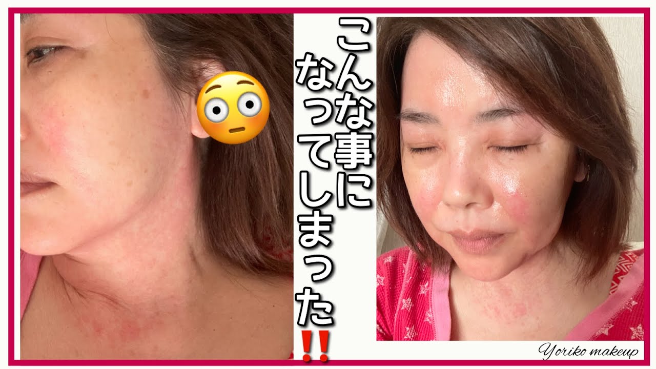 【40代以上に気をつけてほしい】こんな事になってしまった‼️かぶれ❓アレルギー❓【更年期に起こる体調の変化、肌トラブル】