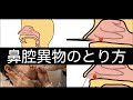 鼻腔異物のとり方