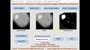 Breast Cancer Detection In Mammography Images Using Neural Network | Breast Cancer Classification