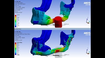 High Load Impact Simulation on the Implant of a Mandibular Fracture - ANSYS WB Explicit Dynamics