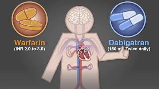 Uninterrupted Dabigatran versus Warfarin for Ablation in Atrial Fibrillation