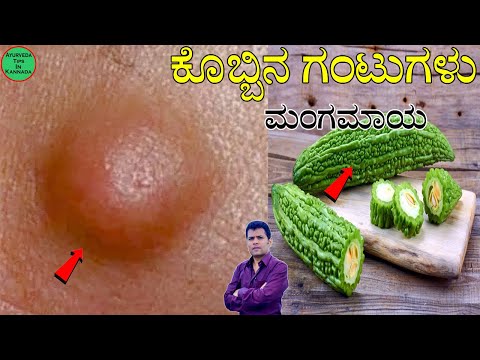 ಲಿಪೊಮಾ ಆಯುರ್ವೇದ ಚಿಕಿತ್ಸೆ | ಲಿಪೊಮ ಮನೆ ಮದ್ದು | ಲಿಪೊಮಾ ಆಯುರ್ವೇದ ಚಿಕಿತ್ಸೆ ಕನ್ನಡ | ಕೊಬ್ಬಿನ ಗಂಟು