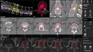 Radiosurgery Solution for Management of Spinal Lesions - Elements Spine SRS