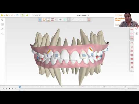 Spark aligners-3D software demonstration by Dr Vandana Katyal for a Class 2, deep bite, teen case