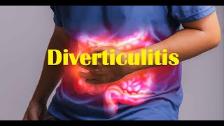 La diverticulitis