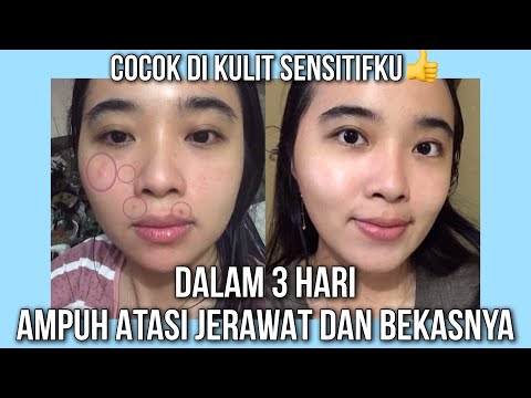 LANGSUNG MULUS!! CARA MENGHILANGKAN JERAWAT DAN BEKAS JERAWAT DENGAN CEPAT DAN ALAMI!!. 