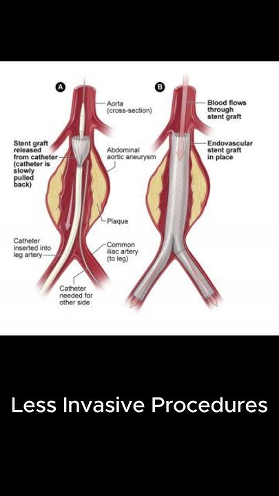 can-an-aneurysm-be-cured-youtube