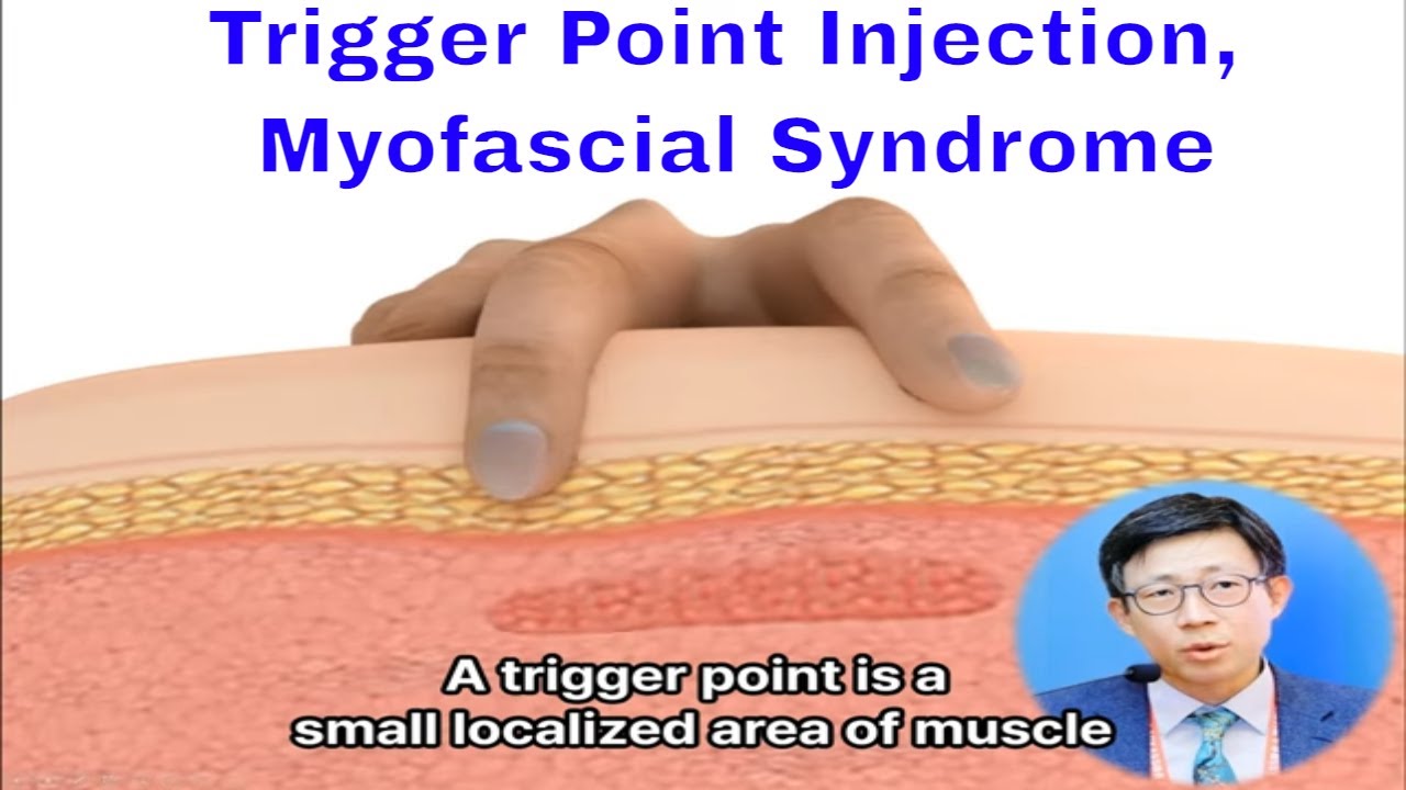 Trigger Point Injection, Myofascial Syndrome - YouTube