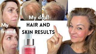 The serum that made my 79-year-old dad's hair grow back | Calecim hair and skin review