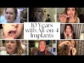 10 years with dental implants