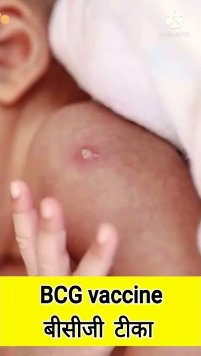 BCG vaccine for newborns |#shorts  | बीसीजी टीका |vaccine |