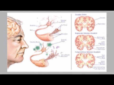 Видео: Обезчестяване на лекарствата на Алцхаймер: Мнение на тълпата