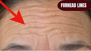 Most Effective Exercise for Wrinkle-Free Forehead | Forehead Smooth ✨#ForeheadWrinkles #faceyoga