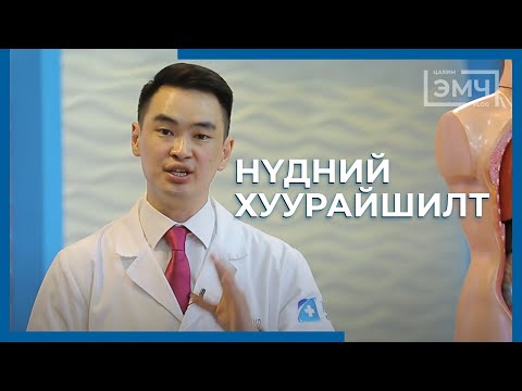 216 - Нүдний хуурайшилт