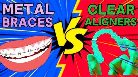 METAL BRACES (BRACKETS) VS CLEAR ALIGNERS (INVISALIGN) - HOW DO THEY WORK?