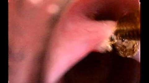 Interarytenoid Scar Surgery Using the OmniGuide CO2 Laser Fiber