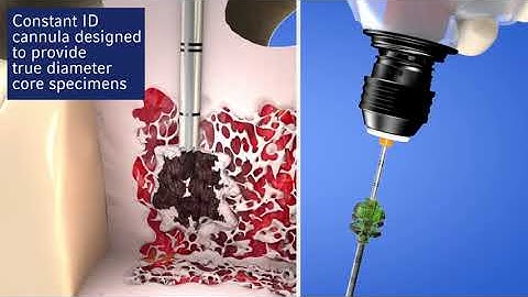 Arrow™ OnControl™ Powered Bone Biopsy System: Innovative Needle Designs for Precise Power