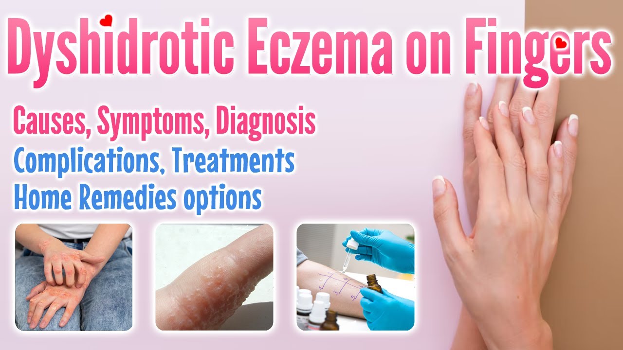 Dyshidrotic Eczema On Fingers Overview Causes Symptoms Treatment