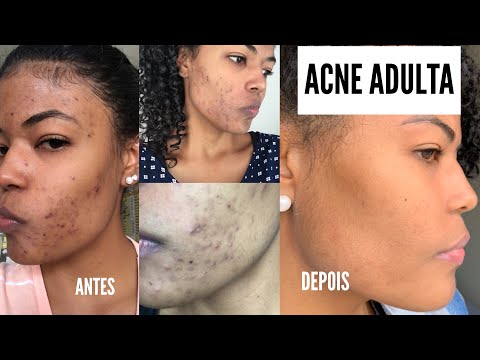 ACNE ADULTA | Minha experiência, tratamento, produtos e manchas! Antes e Depois com fotos.