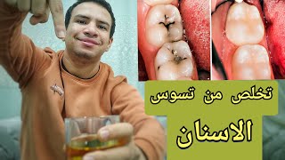 افضل طريقه مجربه للتخلص من تسوس الاسنان | المضمضه بالزيت