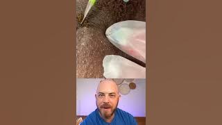 Derm reacts to INSANE ingrown hair extraction! #dermreacts #doctorreacts #ingrownhair