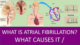 WHAT IS ATRIAL FIBRILLATION ! WHAT CAUSES IT