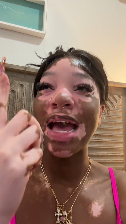 Not The 'Couple' Content 😭 | #vitiligo #explore #explorepage #shortsfeed #movievlog #dinnertime