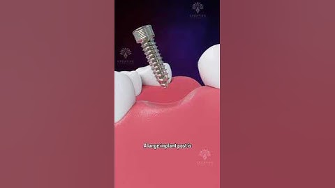 Bone Grafting for Dental Implants #shorts #facts - creativelearning3d