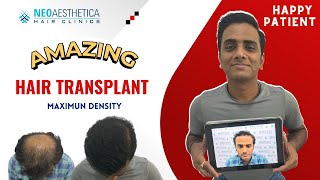 Advanced Hair Transplant Results || Latest Technique || Hair Transplant In Lucknow