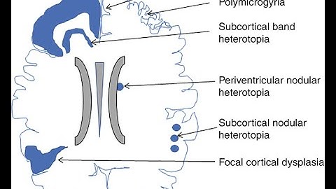 Neuronal Migration Disorders; Schizencephaly, Porencephaly Lissencephaly, Pachygyria, Polymicrogyria