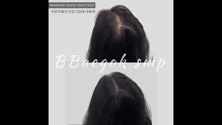 [빼곡smp] 여성 가르마문신 포항두피문신 탈모커버 smp잘하는곳 두피반영구전후