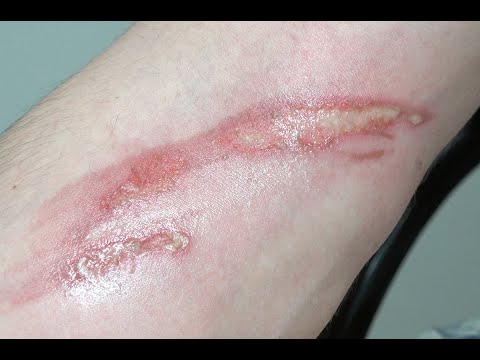 Swanson Chimpy 2nd Degree Forearm Burn,  Silvadene Treatment