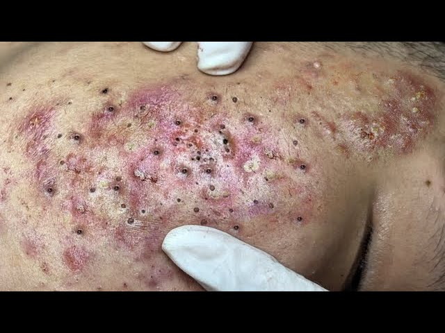 Blackhead Removal With Sac Dep Spa @1000268