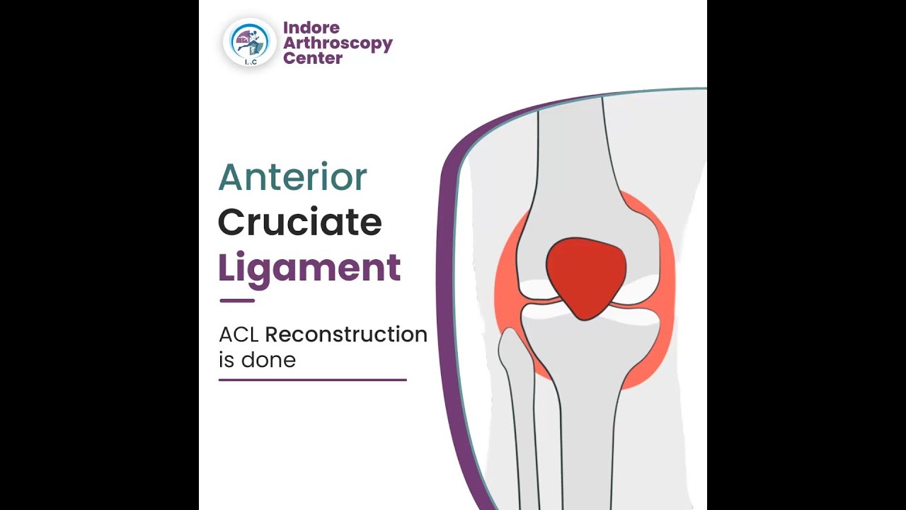 Anterior Cruciate Ligament (ACL) Injuries | Sports Injury Treatment ...