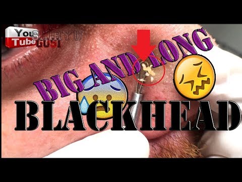 A Big and Long Blackhead and Some Others 4K