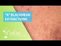 Blackheads Extractions “K’s” 4th Treatment