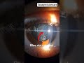 Blue dot cataract#eyehospital #eyes #optometry #eyecare #clinicalskills #clinic #eyecare #cataract