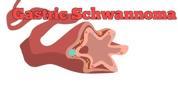 Gastric Schwannoma