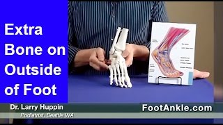 Os Peroneum Extra Bone Outside Of Foot Seattle Podiatrist