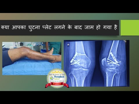 क्या आपका घुटना प्लेट लगने के बाद जाम हो गया है Arthroscopic Treatment of Stiff Knee-Hoffa Fracture