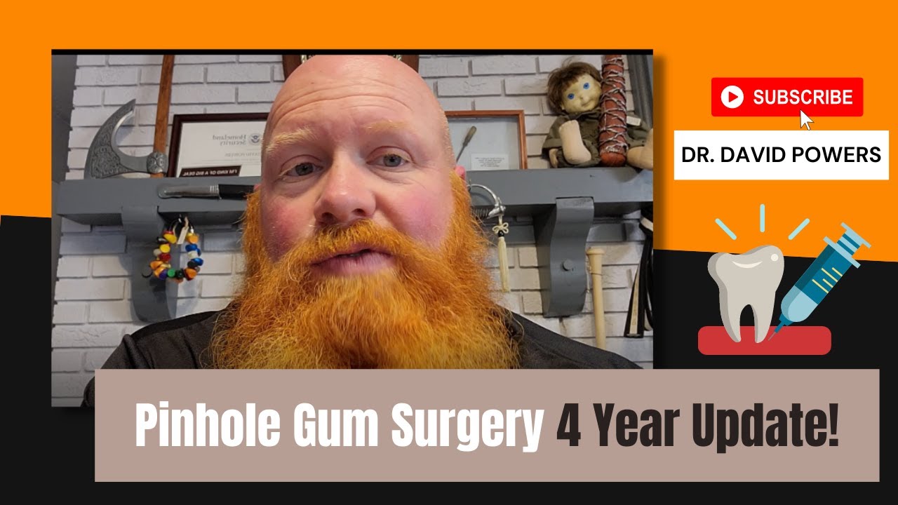 Pinhole Gum Surgery  4 Year Update