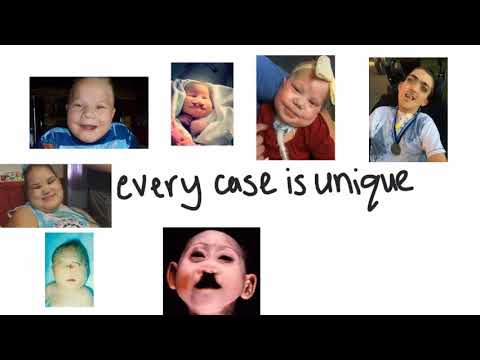 Patau&rsquo;s Syndrome | Trisomy 13 GENETIC disorder