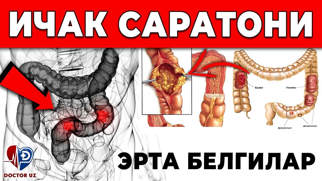 ДИҚҚАТ! ИЧАК САРАТОНИНИНГ ЭНГ БИРИНЧИ ХАВФЛИ БЕЛГИЛАРИ!