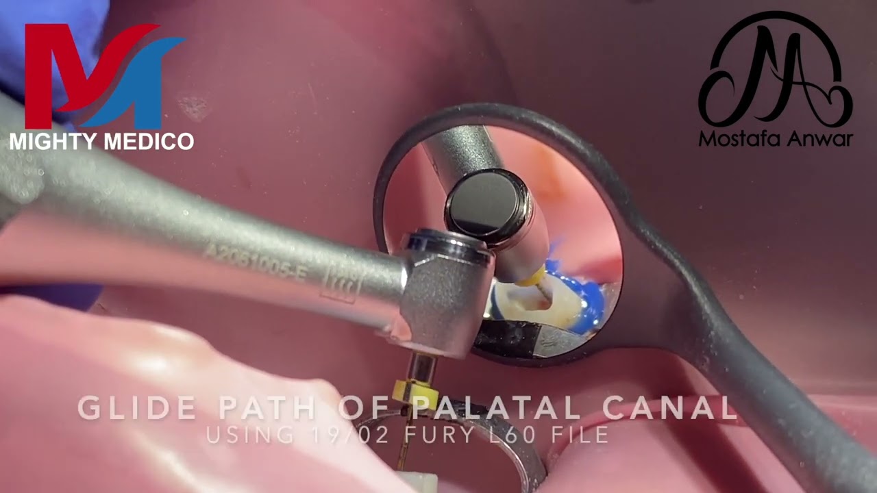 Management of Deep Apical Split in Upper Second Premolar using FURY L60 Rotary System | Narrow Canal