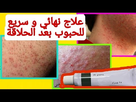 علاج نهائي و سريع للحبوب بعد الحلاقة