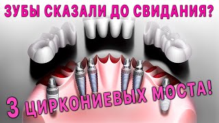 Протезирование без десны на 3 циркониевых мостах.