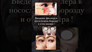 Осложнение после введения филлера в носослезную борозду !