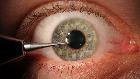 Incision and removal of Foreign body CPT code - simplify medical coding