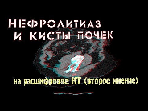 НЕФРОЛИТИАЗ справа, ПЕРЕГИБ мочеточников и КИСТЫ ПОЧЕК Bosniak 1 на РАСШИФРОВКЕ КТ брюшной полости